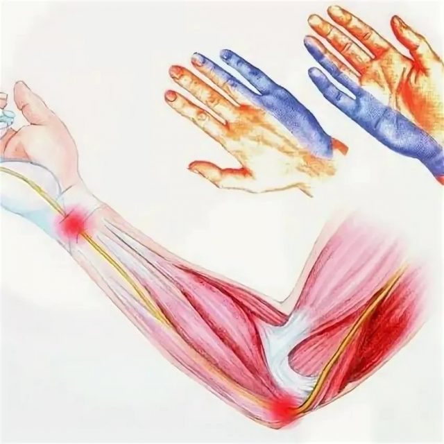 Ulnar canal syndrome - preverehealth.com