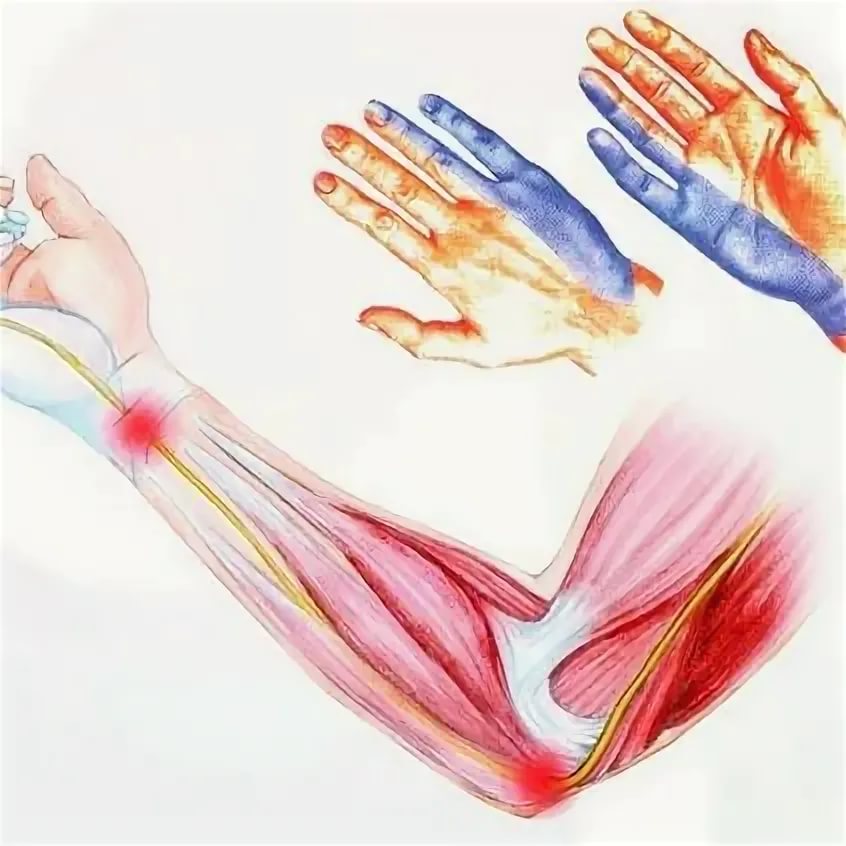 Ulnar canal syndrome